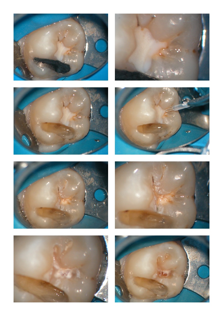 Failing FS in Molar.jpg